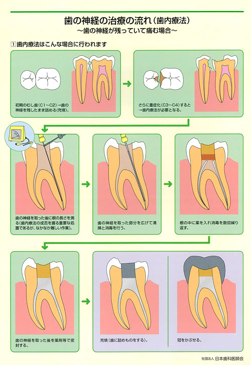 歯 の 神経 腐る 治療