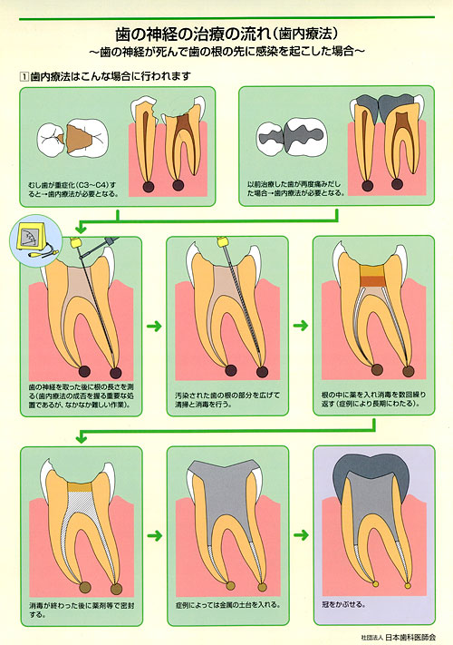 歯の神経の治療の流れ