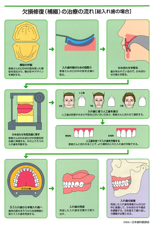 補綴（修復）治療の流れ　総入れ歯の場合